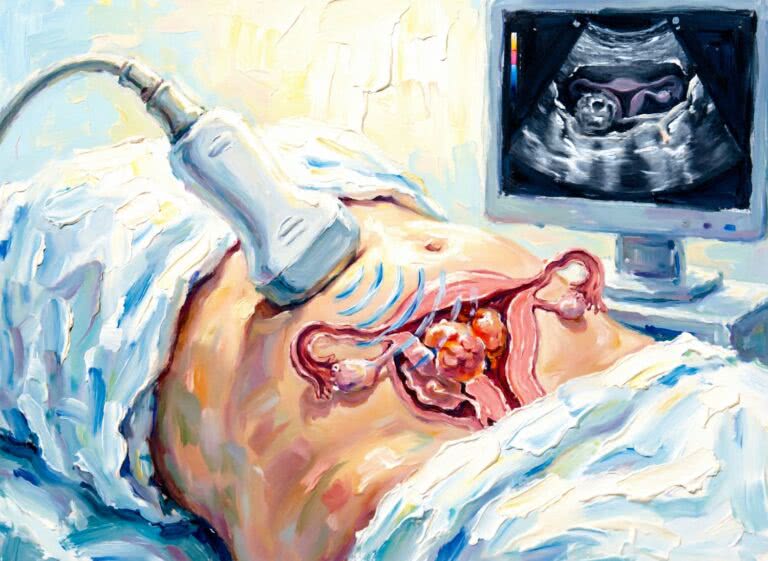 HIFU ginekologiczne – skuteczne leczenie bez skalpela